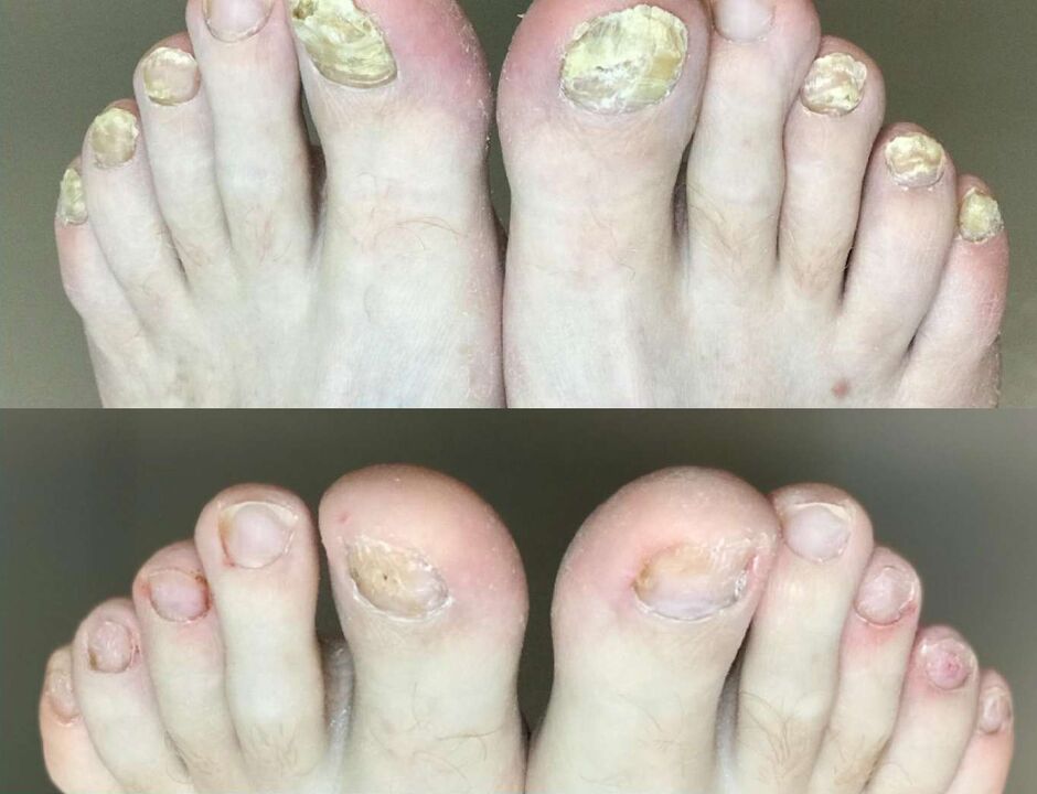 Antes y después del tratamiento, la crema prometida del hongo