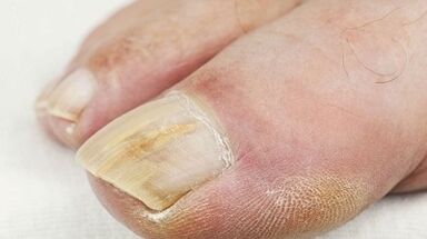 Las razones de la aparición del hongo en el pulgar de la pierna