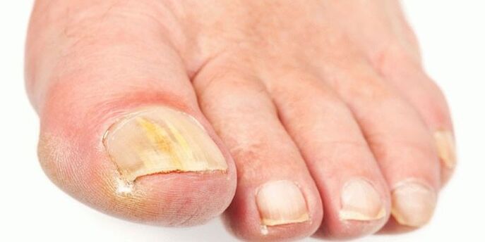 Productos efectivos del hongo de las uñas
