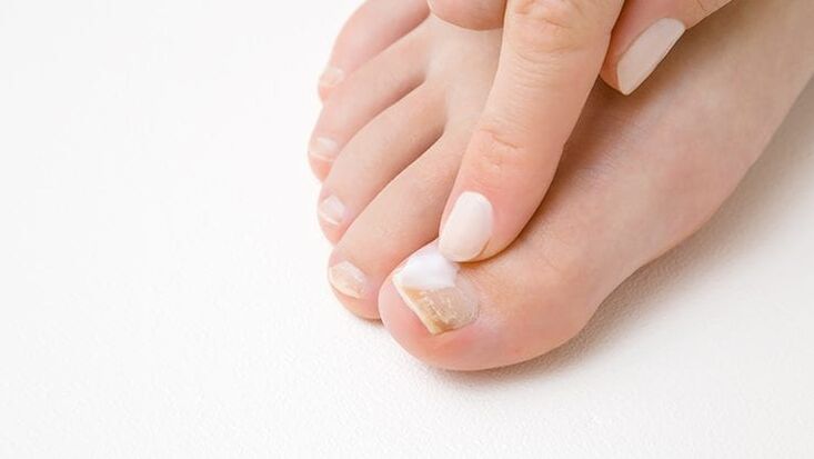 tipo de hongo en las uñas de los pies