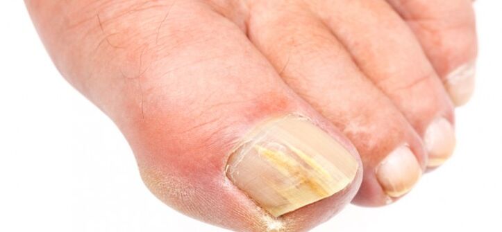 uñas de los pies afectadas por hongos