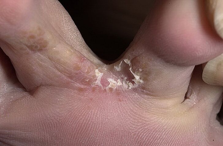 La piel agrietada entre los dedos de los pies es un síntoma de hongo intertriginoso