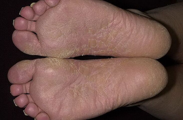 La piel seca y escamosa de los pies es un signo de micosis escamosa