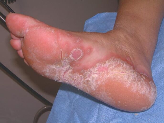 Pie afectado por infección por hongos