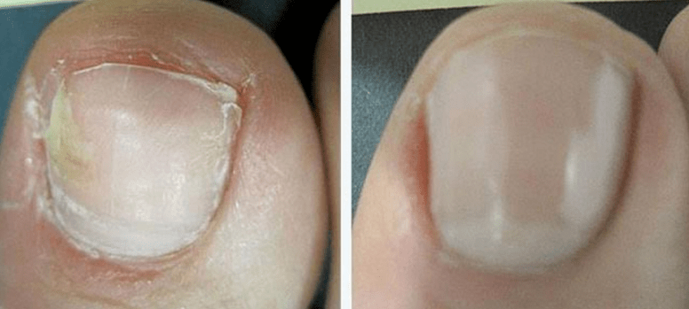Uñas antes y después del tratamiento de hongos.